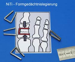 Foot clamp from shape-memory alloy
