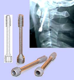 Double threaded screw with cannulas